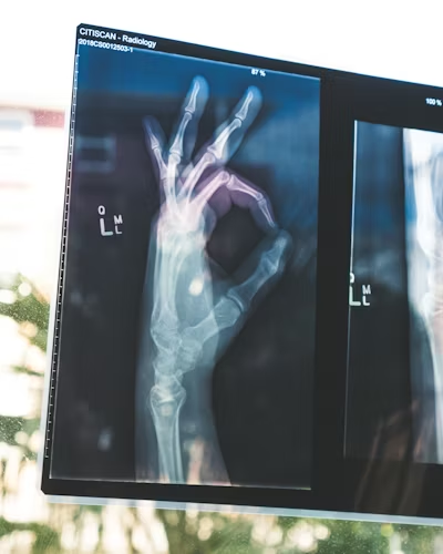 X-ray images showing a hand making an OK gesture displayed on medical viewing screens